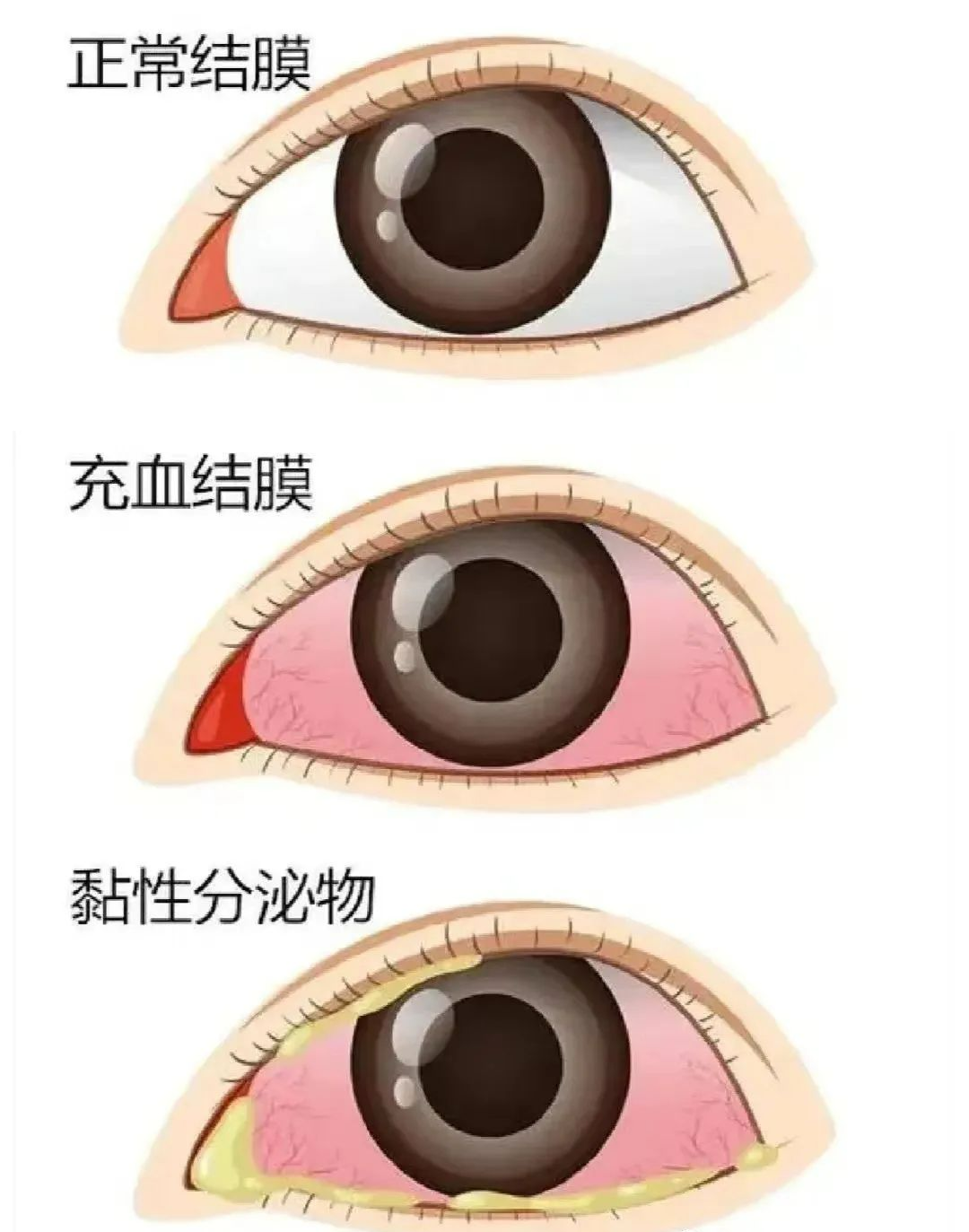 預(yù)防“紅眼病”，呵護(hù)眼健康——?？谑猩礁哂變簣@急性結(jié)膜炎預(yù)防知識(shí)宣傳活動(dòng)-圖片11